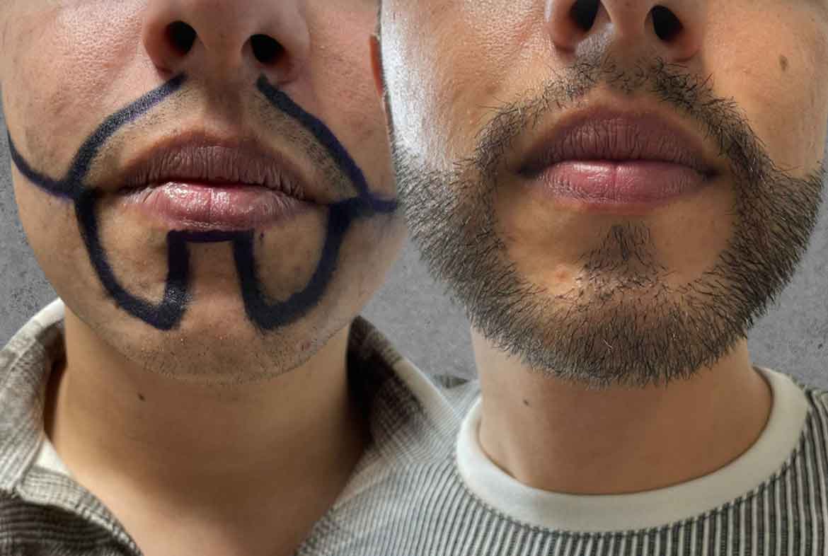 beard-transplantation