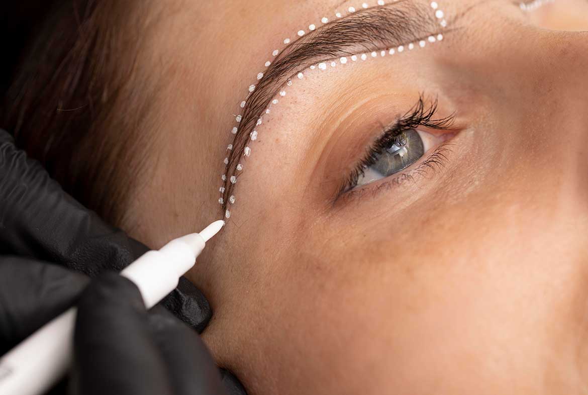 eyebrow-transplantation