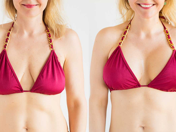 breast-lift-surgery