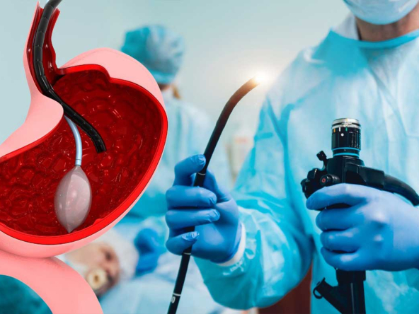 gastric-ballon