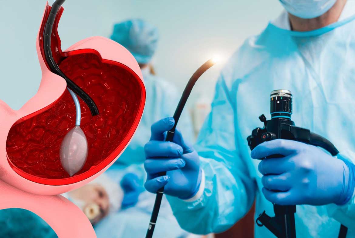 gastric-ballon